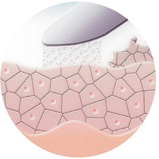  Abgestorbene Zellen werden abgetragen